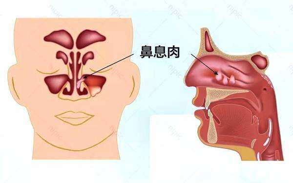 想知道洗鼻的功效,首先要知道在鼻炎情况下,鼻子内部构造是怎么样的
