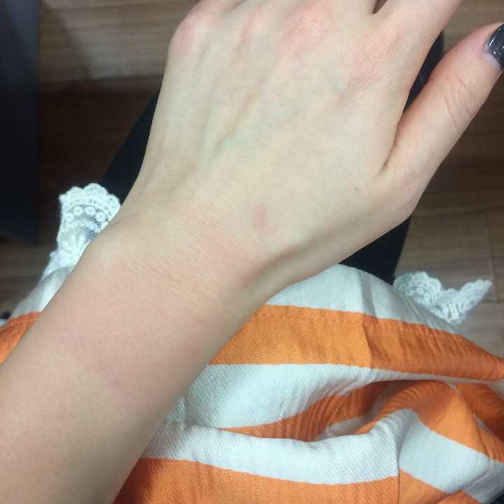 贴膏药过敏怎么办?