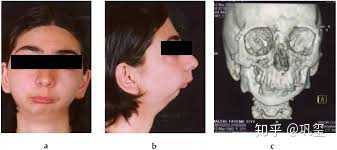 小(下)颌畸形(micrognathia):又称"鸟嘴畸形":是由先天性发育畸形