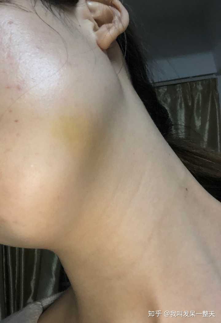 是否会脸肿和智齿的难度,拔牙时间,患者免疫力,以及术后的措施有关.