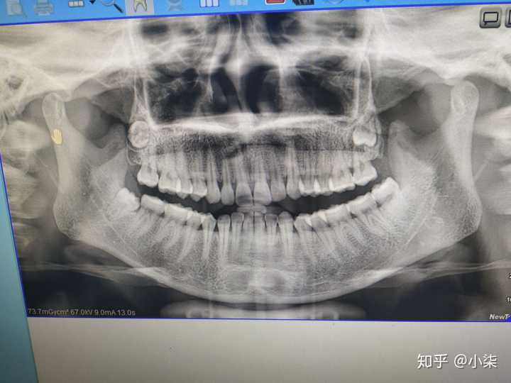 有没有类似生长的智齿?上颌骨有颗智齿长得太有个性了
