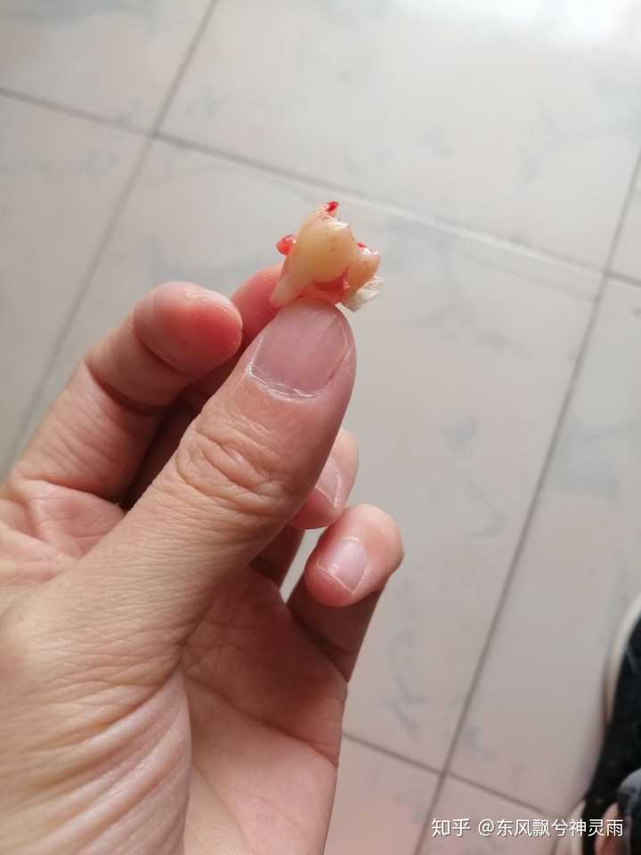 你们拔智齿时有多疼?