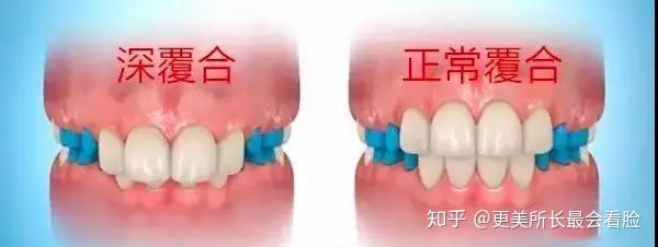 凸嘴是困扰很多人颜值问题,而齿性深覆合和凸嘴问题有着很大的联系