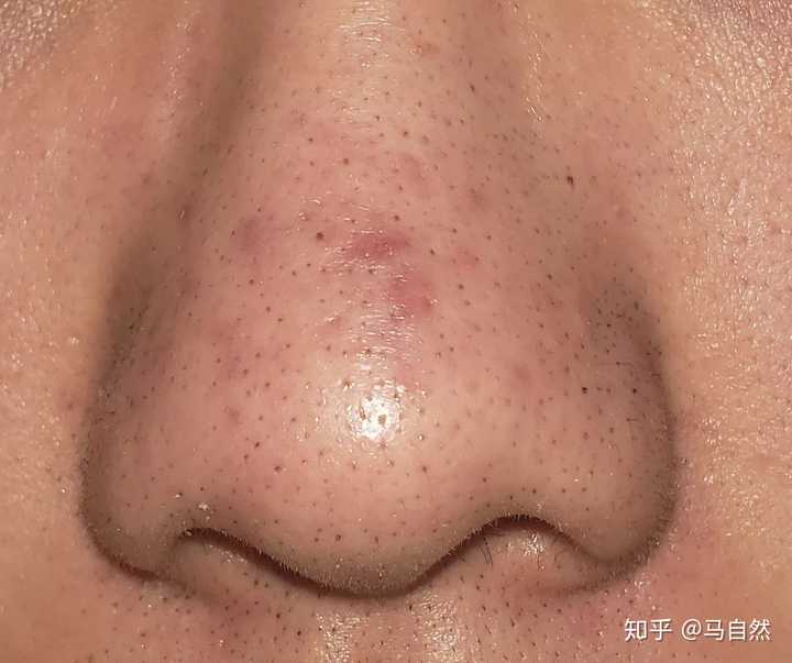3油脂颗粒黑头(普通类型)