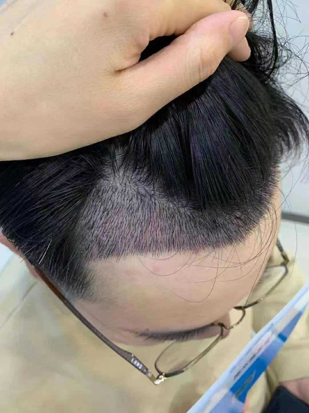咨询植发 知乎