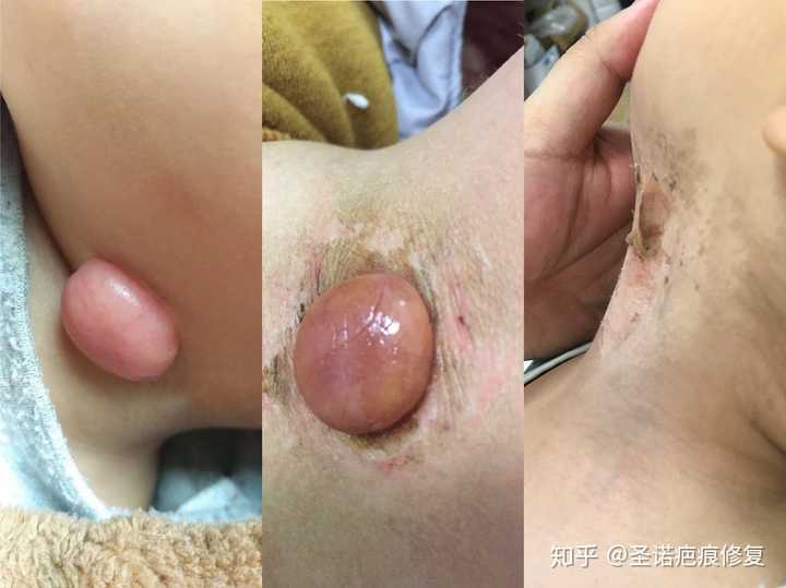 如果把增生疤痕突出的肉弄掉愈合后会变平吗?