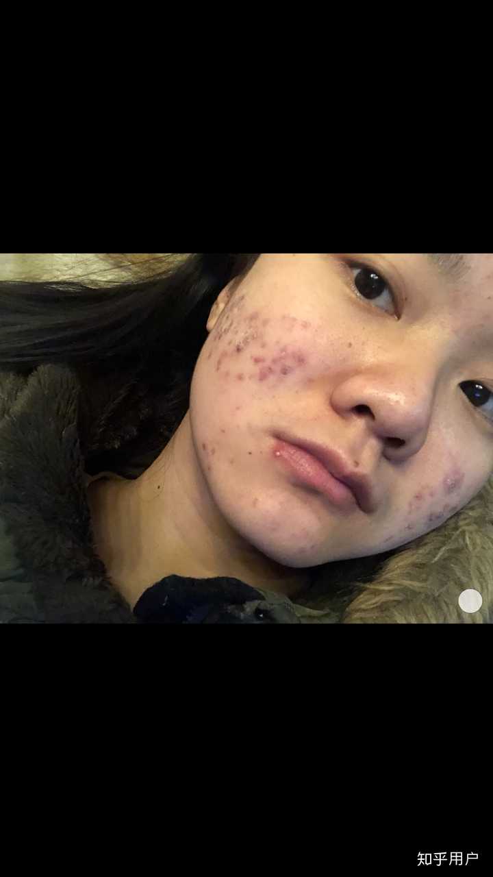 刚开始烂脸的时候