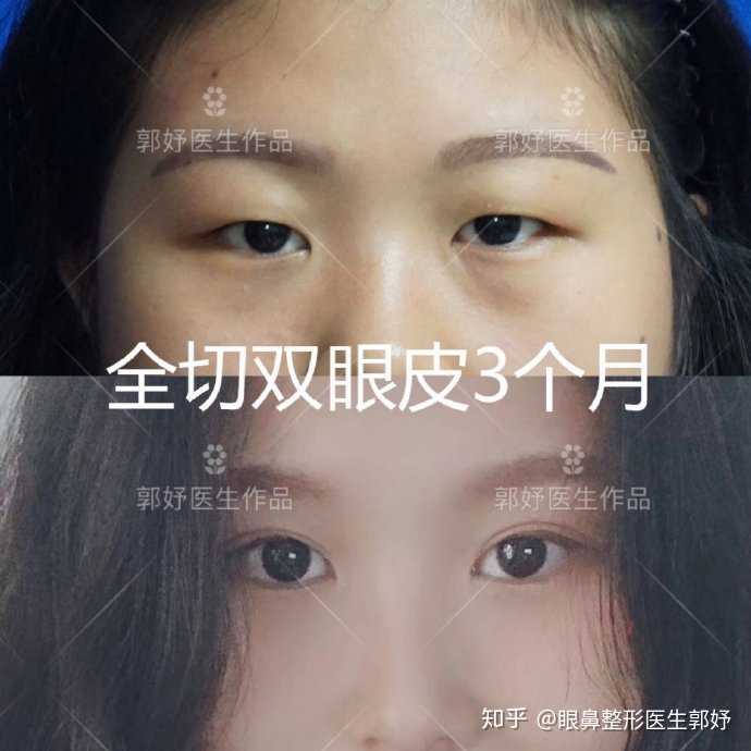 我这样的肿眼泡还内双怎么救?