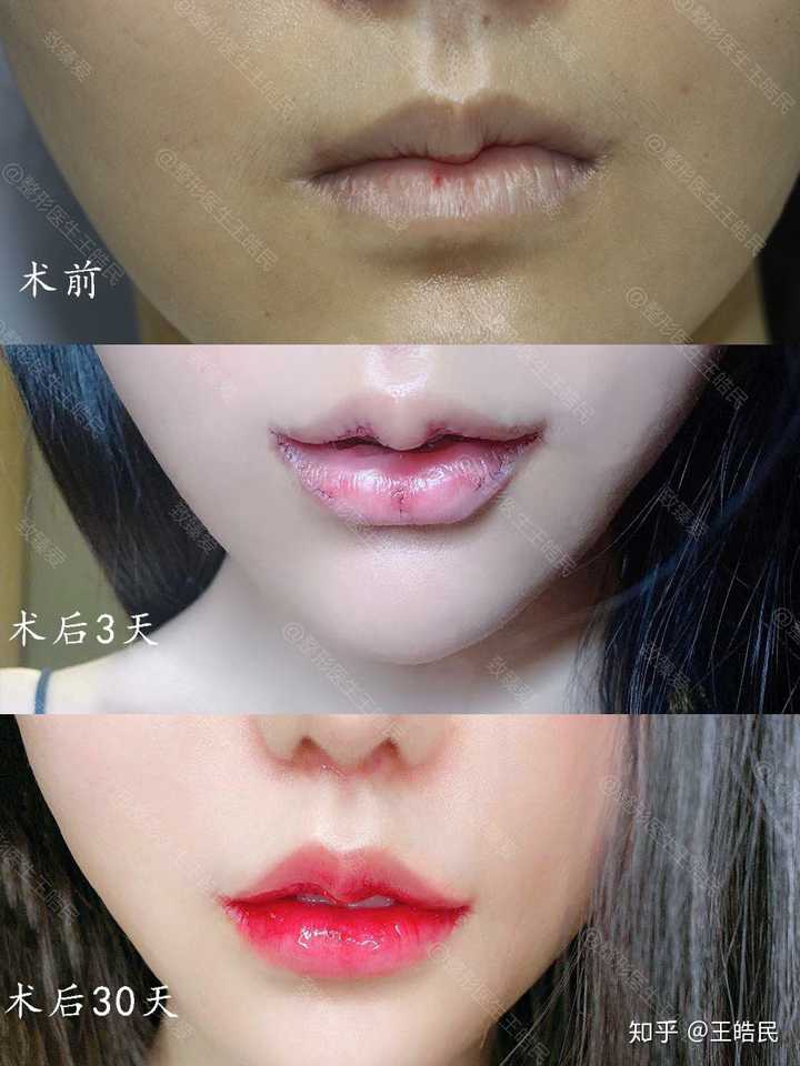 我感觉自己嘴唇有点厚,是要做m唇还是厚唇改薄?