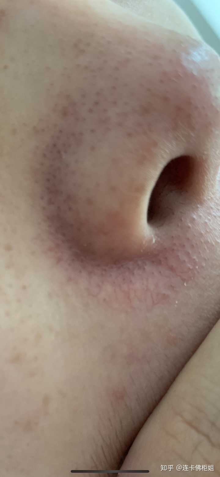 色素沉淀,或者小毛刺 估计你的和下面这些很像: 针对普通意义上的黑头