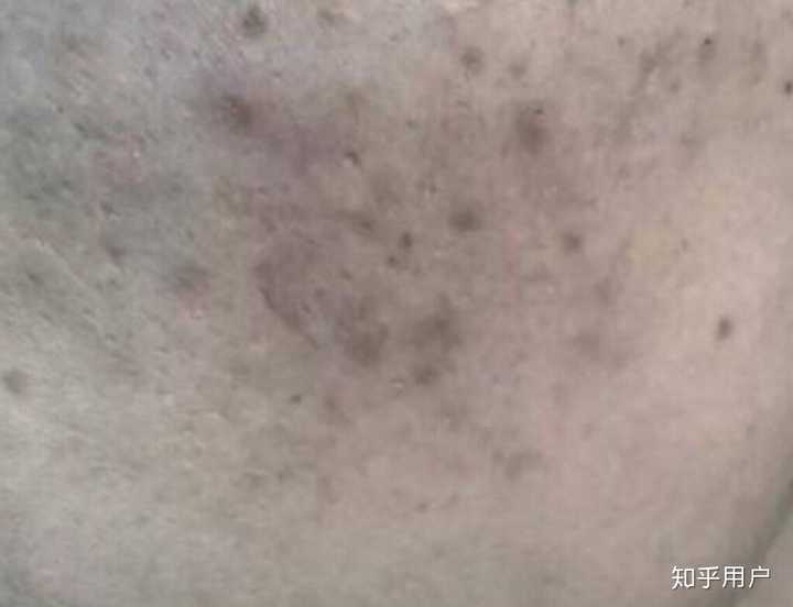 这种痘印比较顽固,是由红色痘印护理不当,黑色素沉淀导致的.