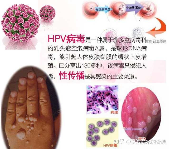 人乳头瘤病毒(hpv)疫苗有必要打吗?