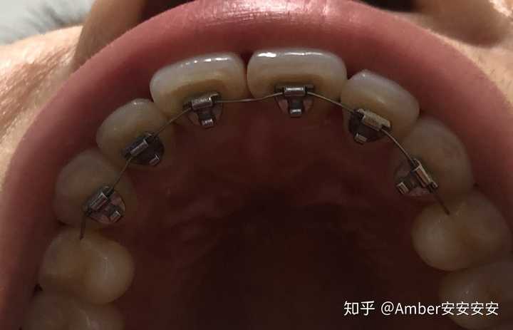 戴牙套一般要多久 知乎