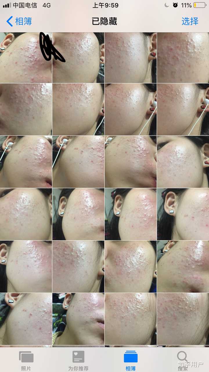 怎么去闭口?