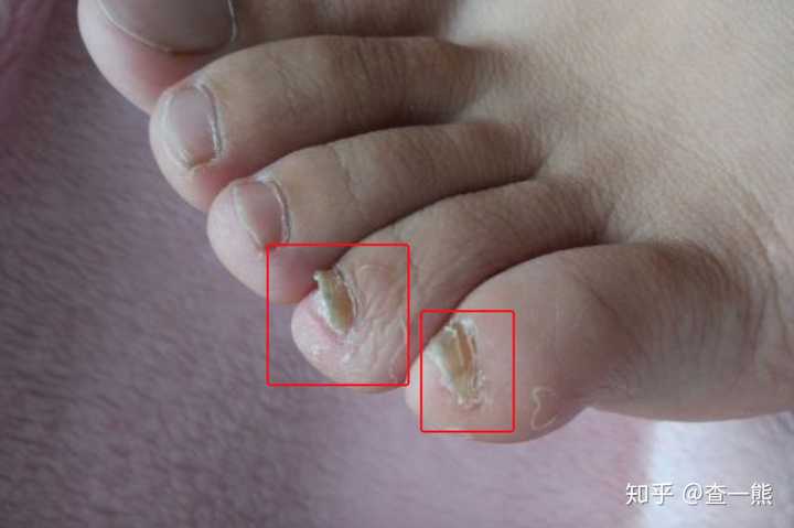 根据症状图判断,是真菌感染引起的灰指甲,症状表现为甲增厚,甲萎缩