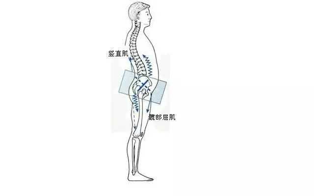 如何科学地判断自己是否患骨盆前倾,如何矫正骨盆前倾