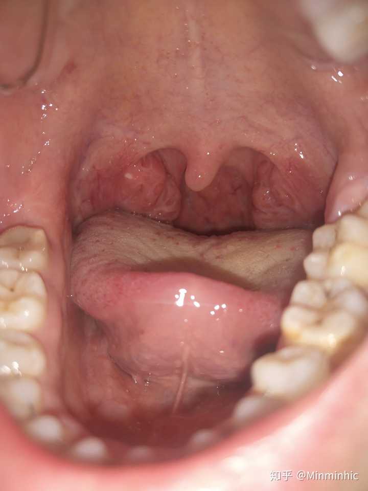 扁桃体结石是如何形成的?