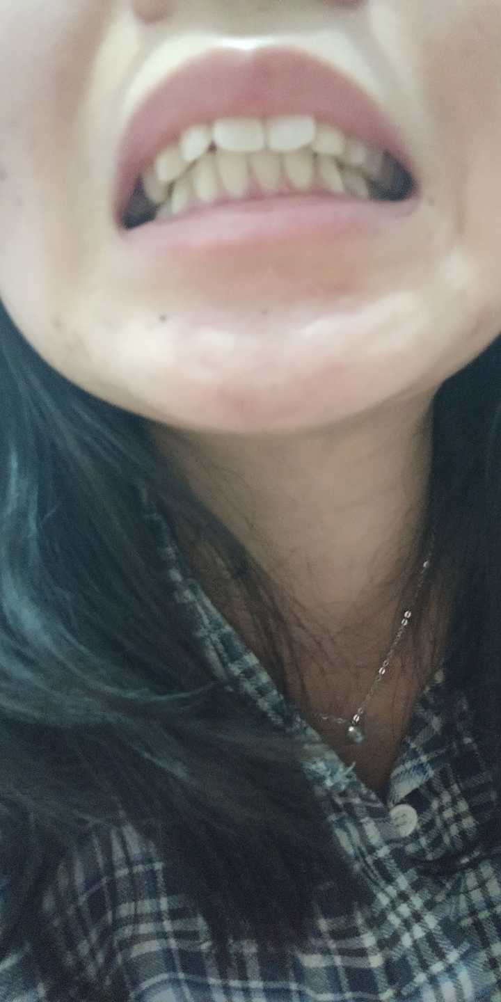 有没有整牙后变更丑的案例?