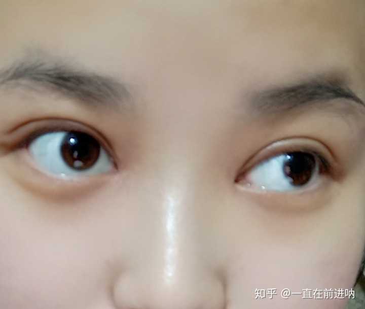开眼角形成的疤痕多久能消啊?