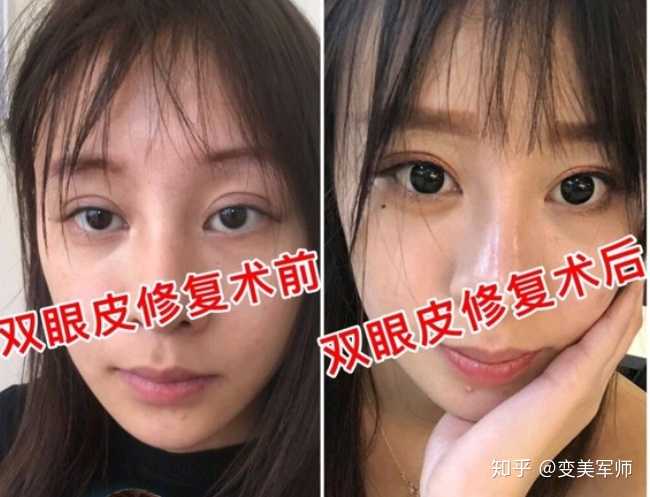 割双眼皮失败是什么样子的?
