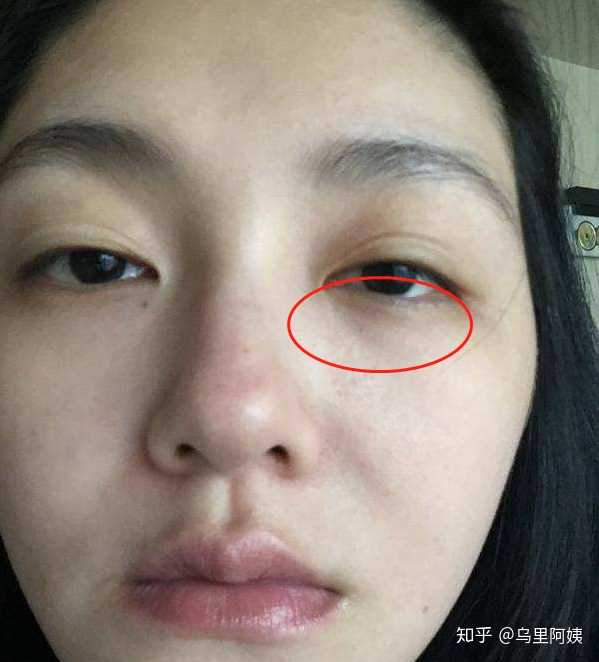 黑眼圈是怎么形成的,可以修复好吗?