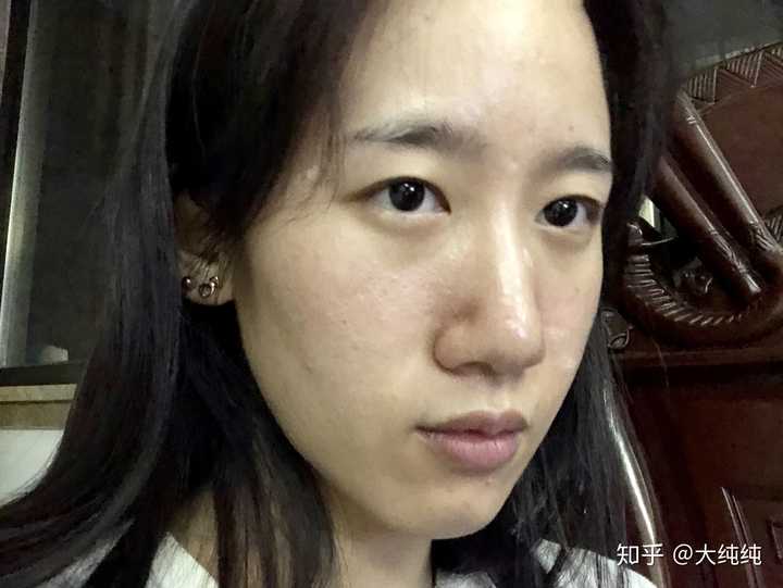 女生皮肤很差毛孔粗大长痘痘怎么办