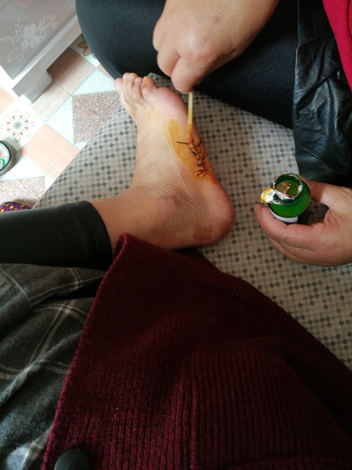 左脚第五根跖骨骨折?