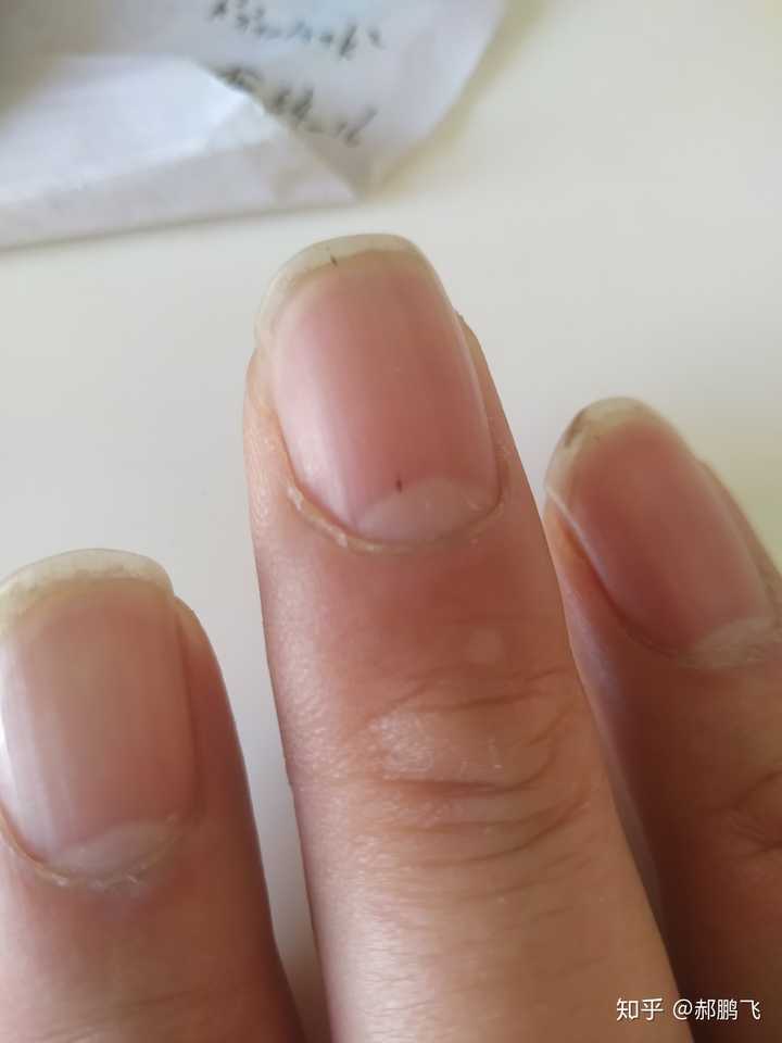 拇指指甲盖有个黑点,像是针刺穿的,隐隐的疼,不是淤血