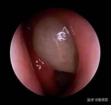 鼻息肉手术填充物取出来后就可以用鼻子呼吸吗?