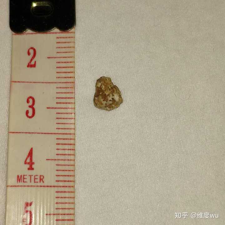 7的肾结石能自己排下来吗?