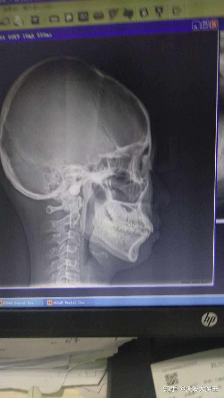 侧脸丑而正脸好看是一种什么体验?