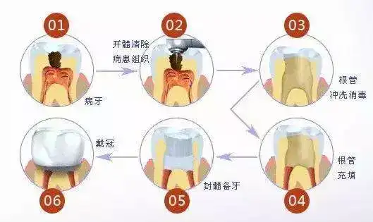 根管治疗后一定要做牙套吗?