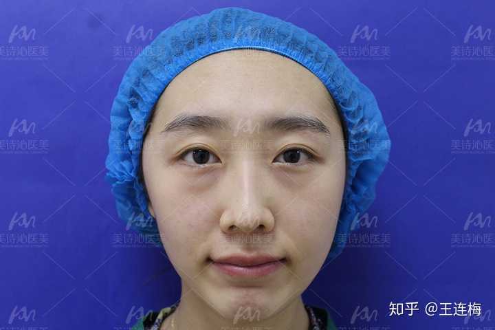 请问一笑就会出现在卧蚕下面的凸起是什么?