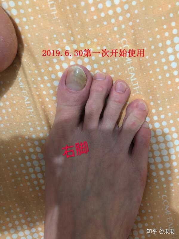 这么多都没有说用什么药能治灰指甲.