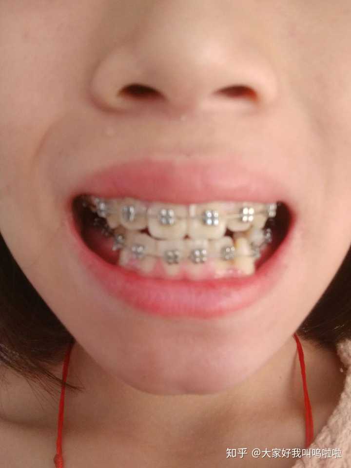 带牙套很疼痛是真的吗?