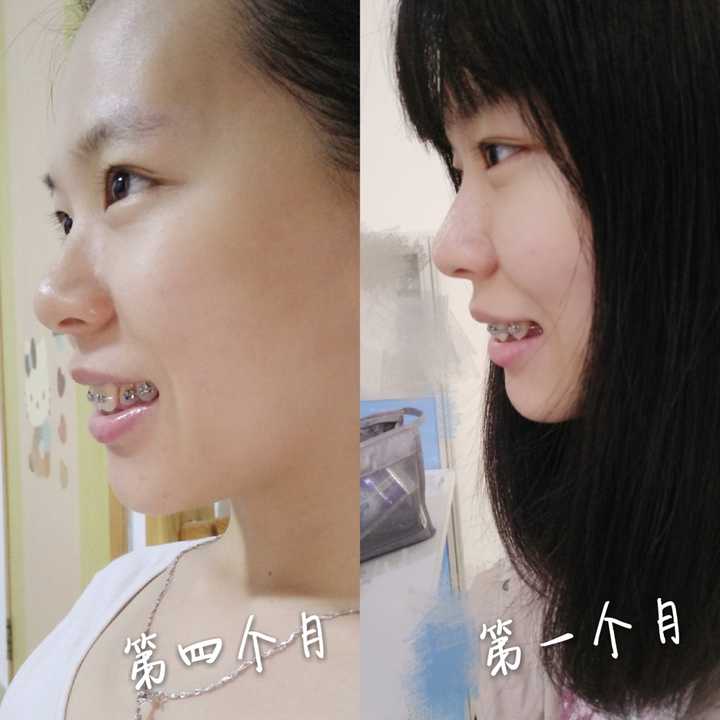 不过脸确实瘪了…胶原蛋白啊…还是得多吃多吃哦,避免牙套脸啊… 第
