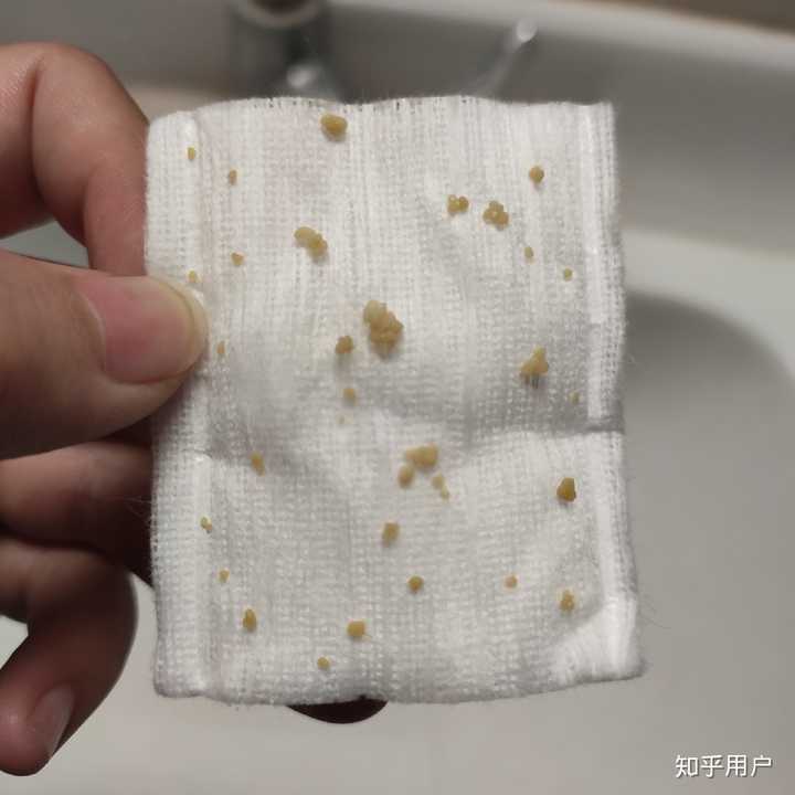 扁桃腺结石怎么清理?