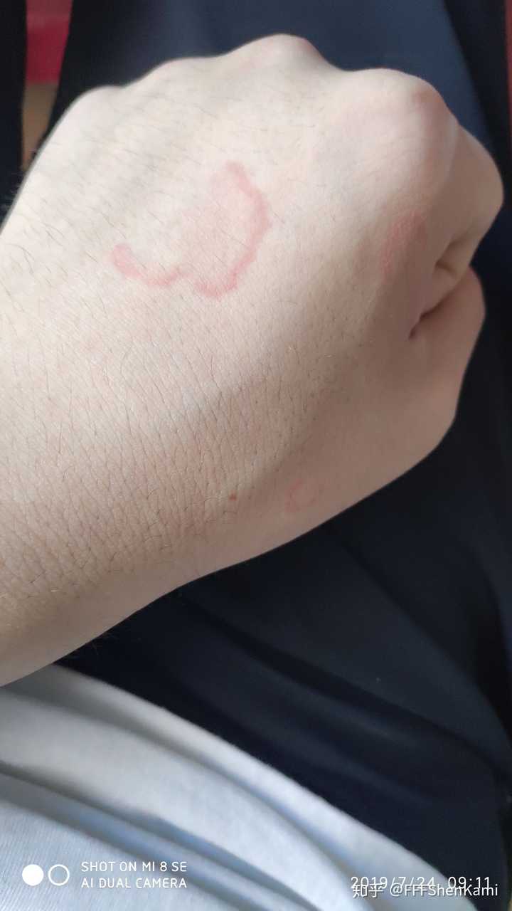 得了荨麻疹是一种怎样的体验?