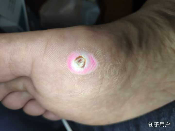 鸡眼怎么判断是否已经痊愈?
