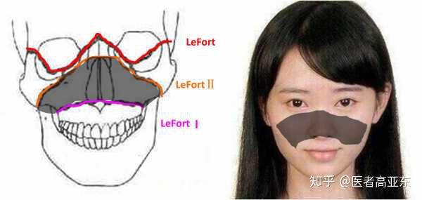 所以真正的鼻基底提升,应该是整个面中部的提升,也就是上颌骨的骨块