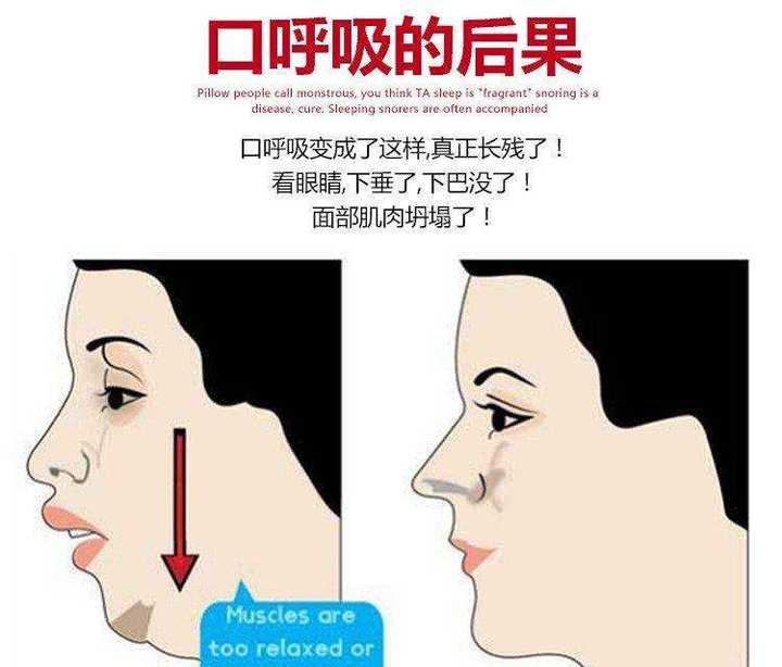 「口呼吸」对健康与面容有何影响,如何科学预防与矫正