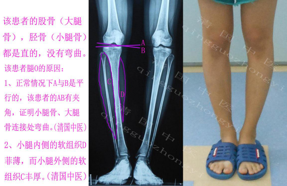 具体成因如下:1,小腿骨真的弯了.包括胫骨骨干弯曲和胫骨平台塌陷.