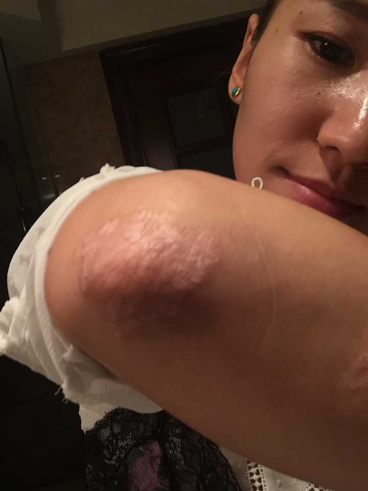 女生得了牛皮癣是一种什么体验?能治好吗?