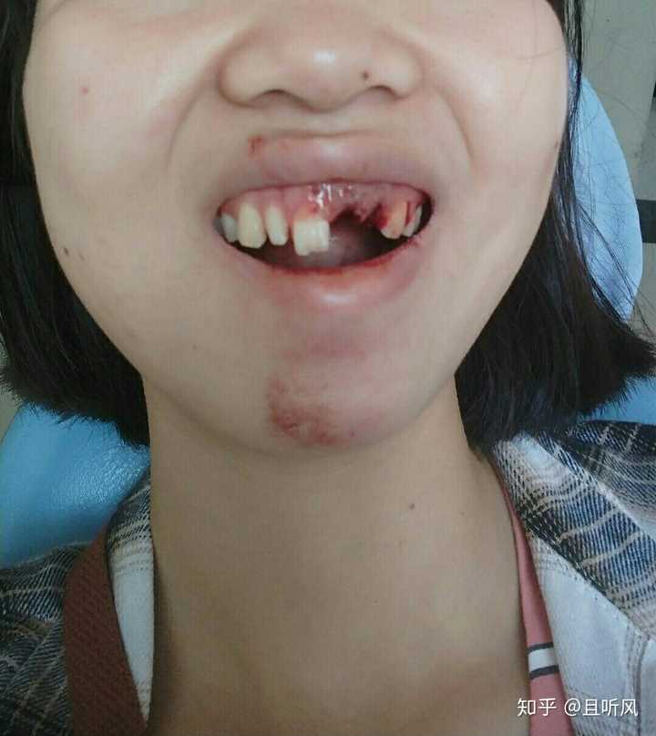 然后两点多,做了一个小手术,把掉的牙安上去了.