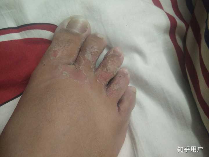 水泡型脚气和汗疱疹的区别?