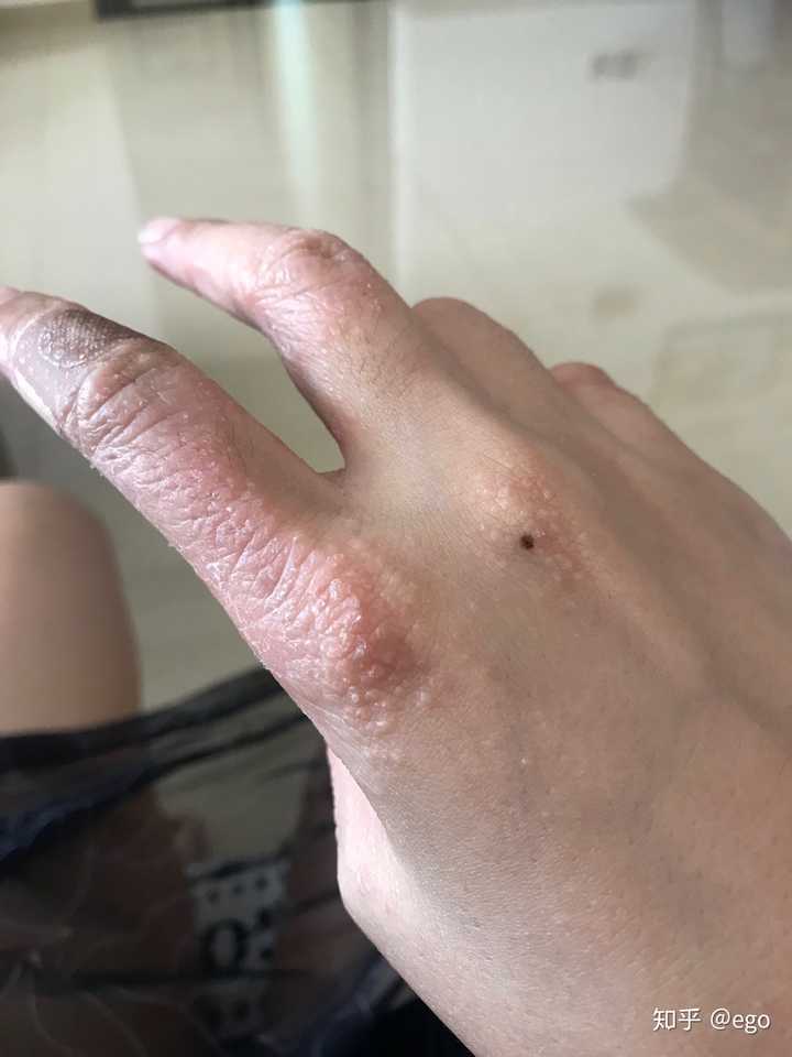 湿疹的最佳治疗方法是什么?