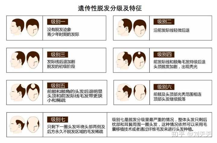 有遗传性脱发这种说法吗?