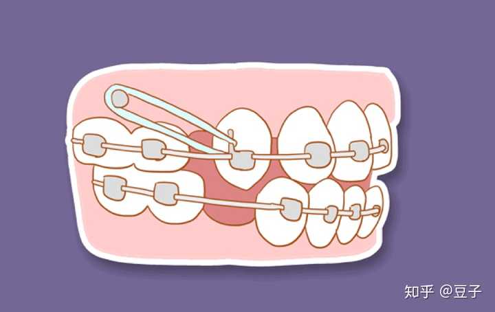 牙齿矫正的原理是什么?对牙齿神经会有负面影响吗?