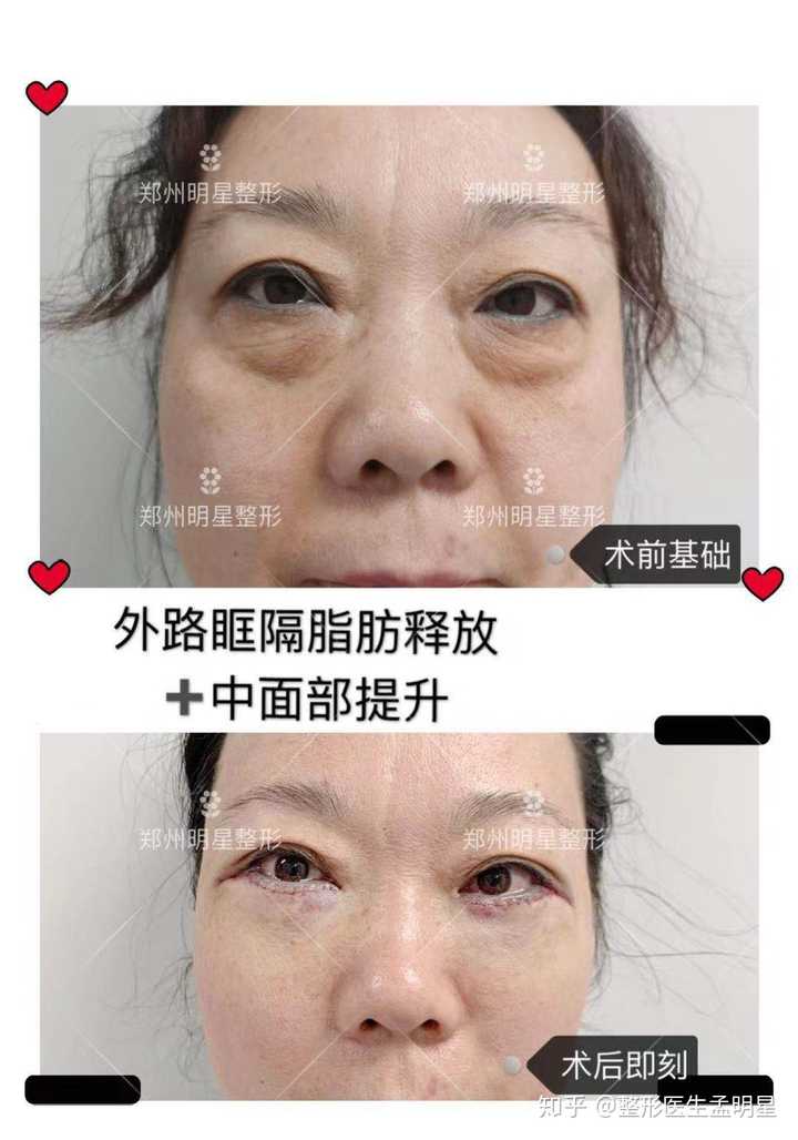 我的眼袋感觉蛮大的,眼袋大是什么原因?有什么解决办法啊,感觉很难看