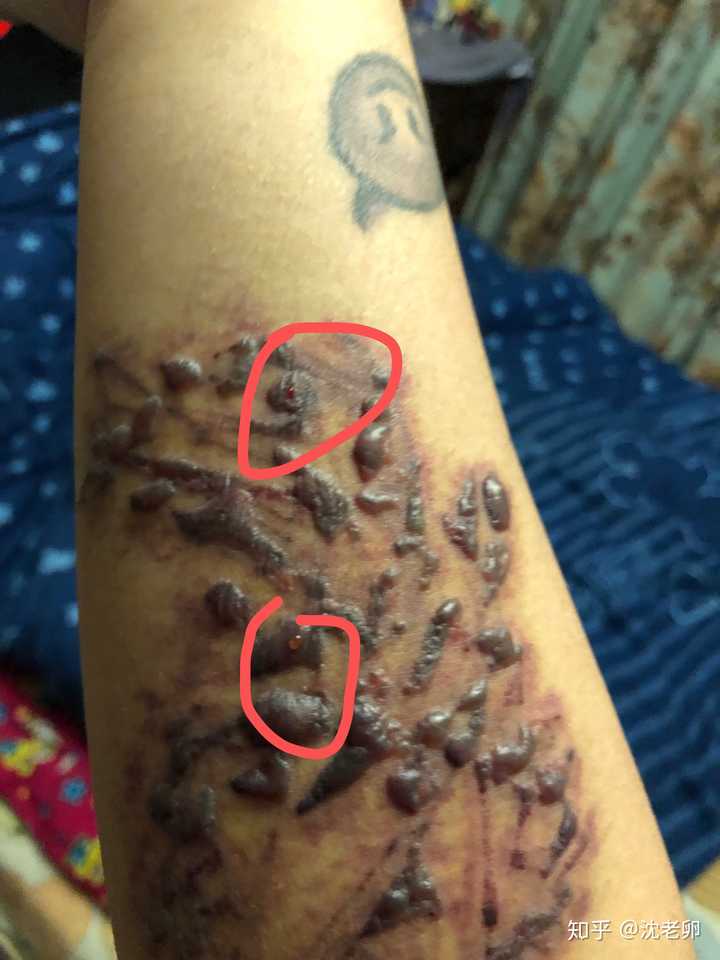 洗纹身起水泡了怎么办?